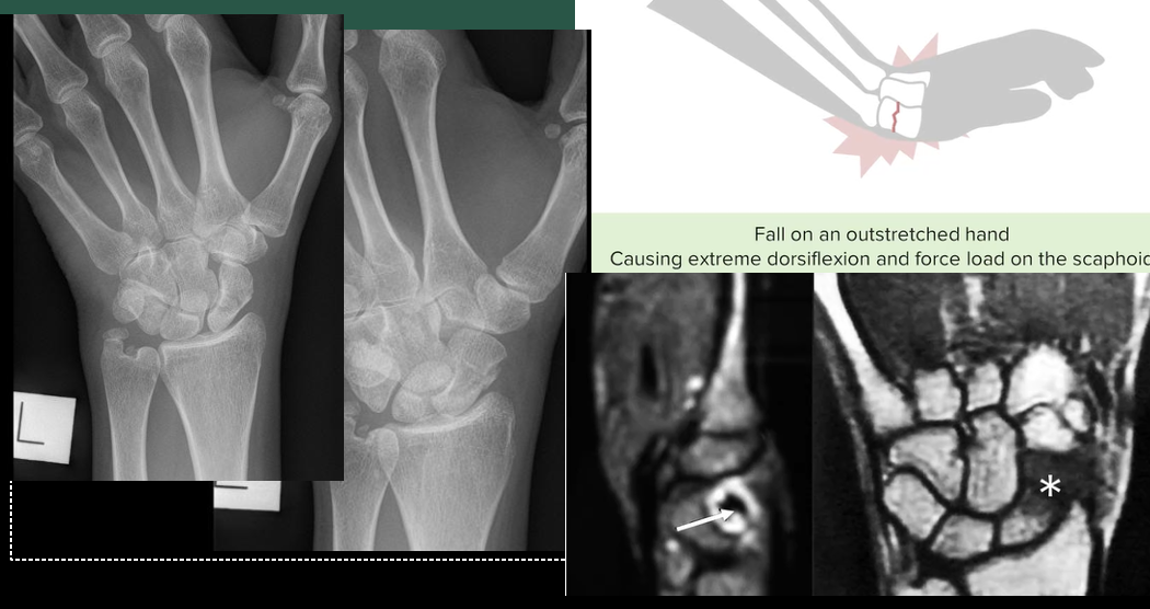 <p>Anatomical Snuff Box Fracture. A &quot;snuff box fracture&quot; refers to a specific type of wrist fracture that involves the scaphoid bone and often occurs as a result of a fall on an outstretched hand.</p>