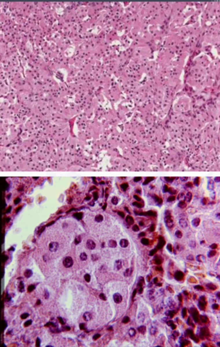 <p>Large polyhedral cells with abundant granular cytoplasm</p><p>▫ Mitochondria</p><p>Cells are separated by thin fibrous septal</p>
