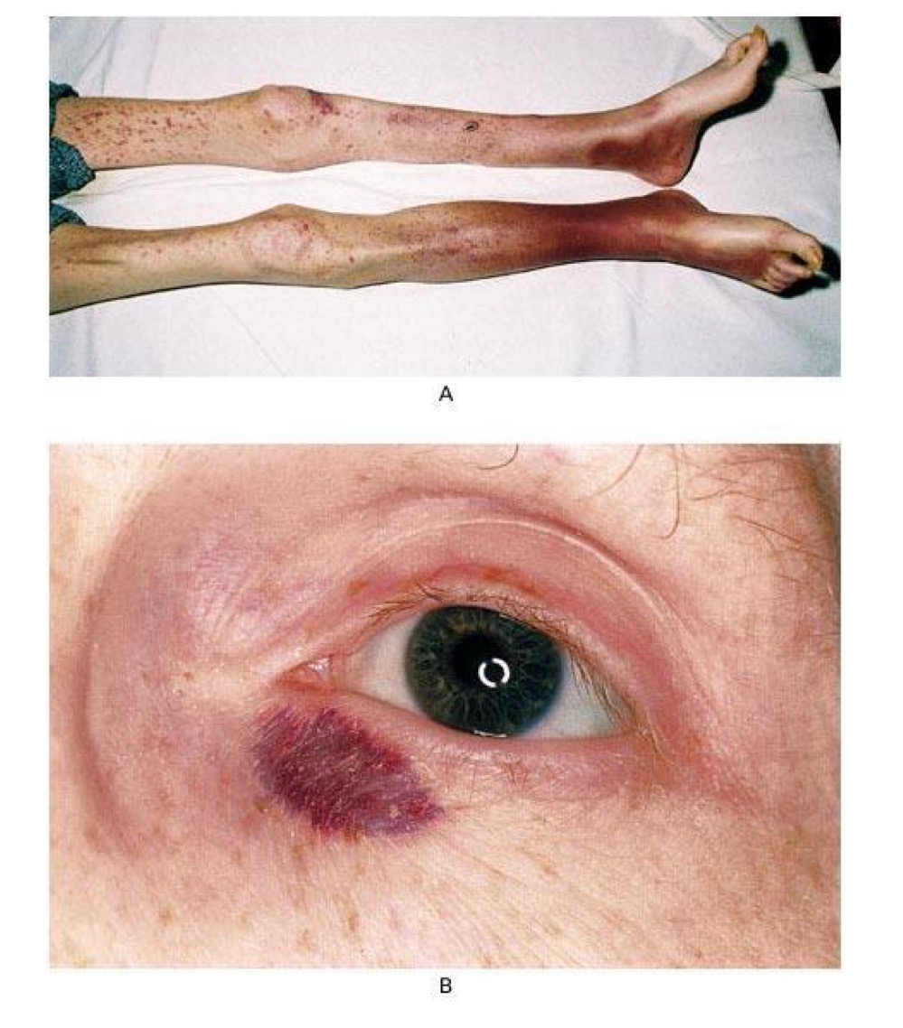 <p>what type of skin lesion is this? </p>
