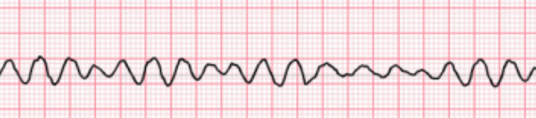 <p>Determine the ventricular dysrhythmia:</p><ul><li><p>Rate is rapid, uncoordinated, and ineffective</p></li><li><p>Rhythm is chaotic and irregular</p></li><li><p>P waves: none</p></li><li><p>Always pulseless</p></li></ul><p></p>