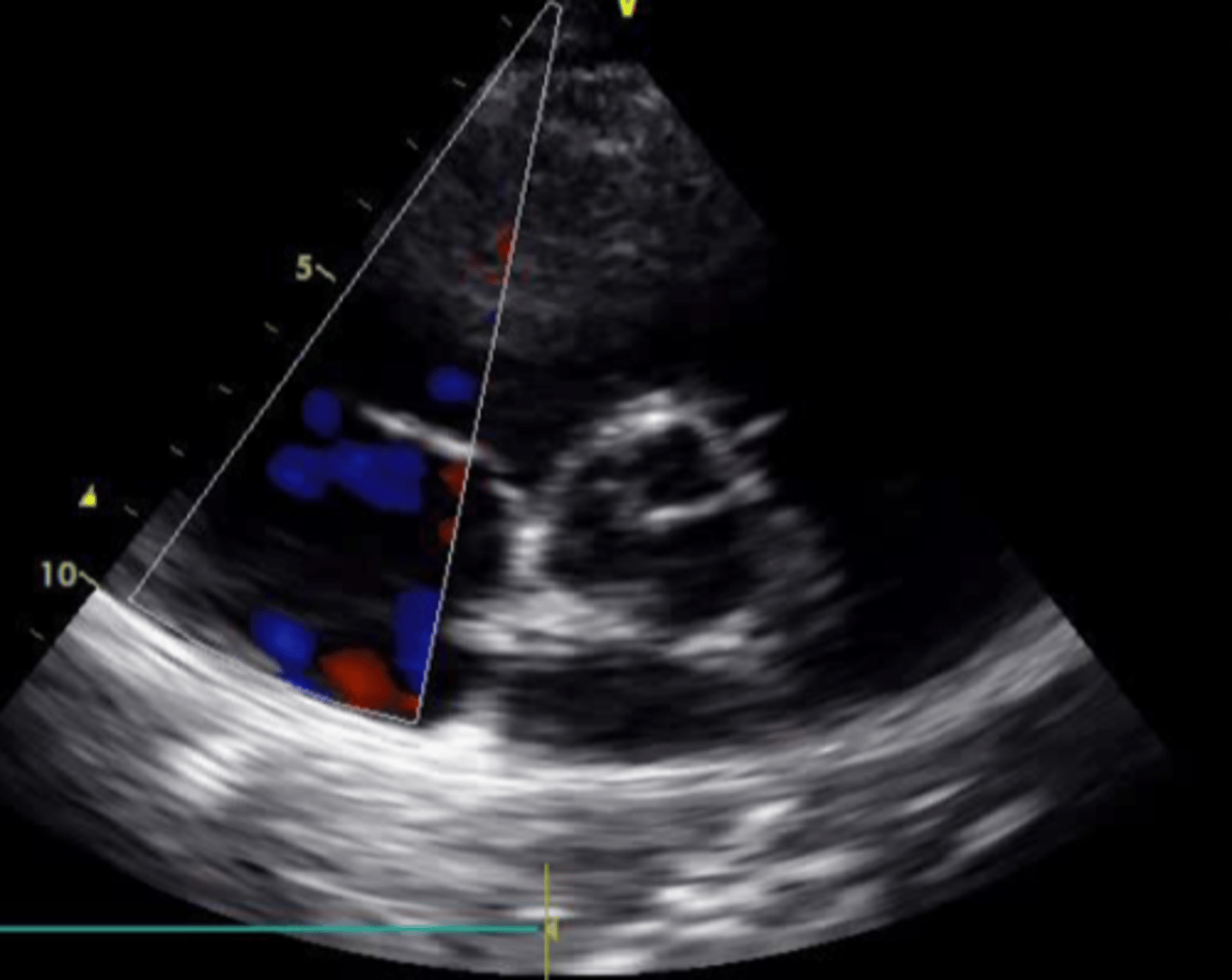 <p>anterior tricuspid valve leaflet</p>