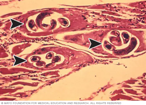 <p>Trichinosis</p>