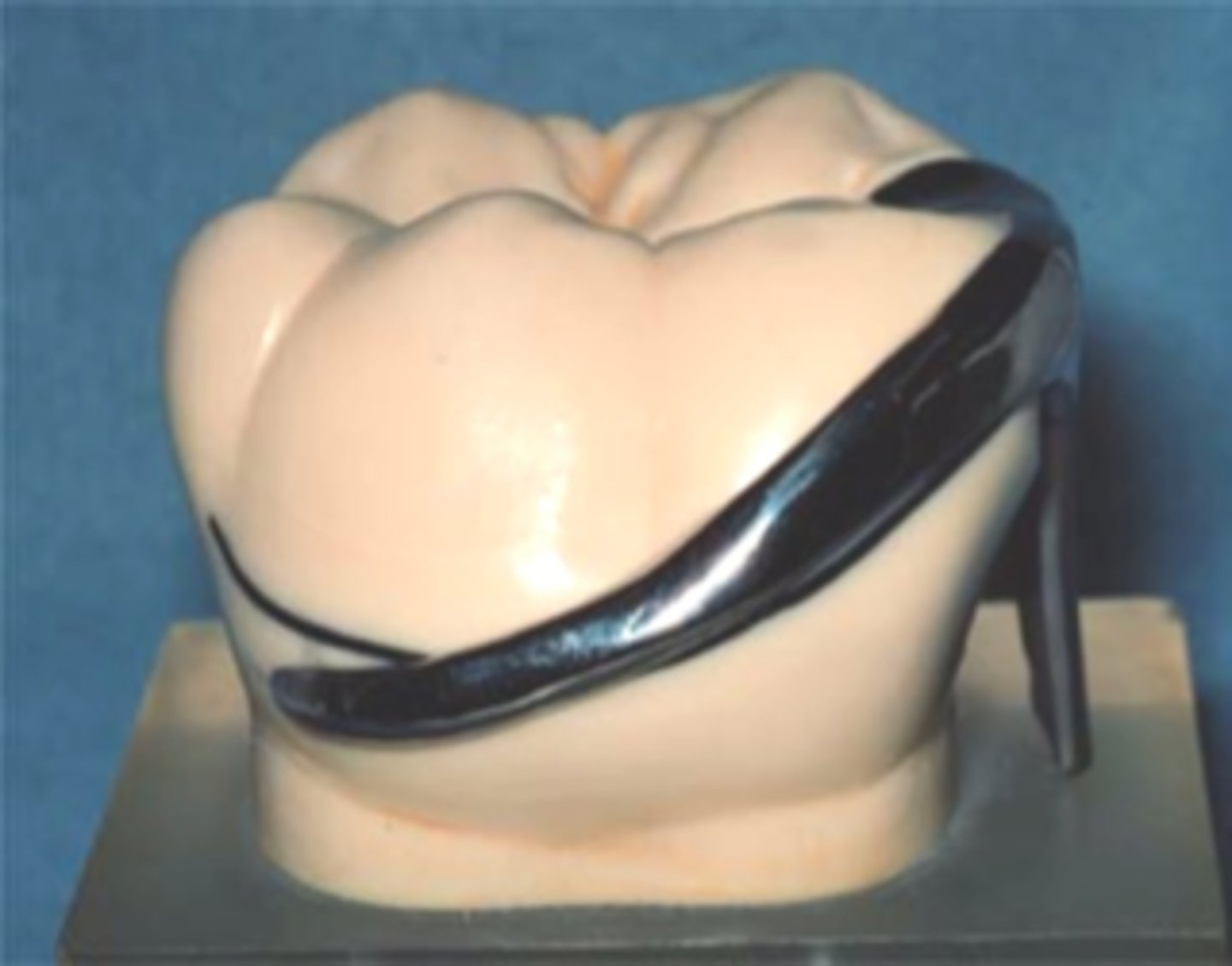 <p>clasp </p><p>• Begin above height of contour (rigid)</p><p>• Retentive tip in gingival 1/3 of tooth, below the survey line (flexible)</p><p>• Middle portion as low as possible but above survey line (*too close to occlusal surface à occlusal interference)</p><p>• In tooth-supported situations, stress release usually unnecessary, so Akers and embrasure clasp assemblies are ok to use</p><p>•Cast Circumferential clasp (Akers)</p><p>•Double embrasure clasp</p><p>•RPC (aka RPA) clasp (mesial rest, proximal plate, circumferental clasp). Due to the rest location, this clasp assembly provides stress release, but can be used when this is not necessary</p>