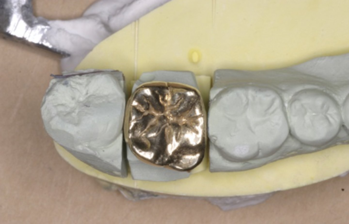 <p>What type of crown is shown?</p>