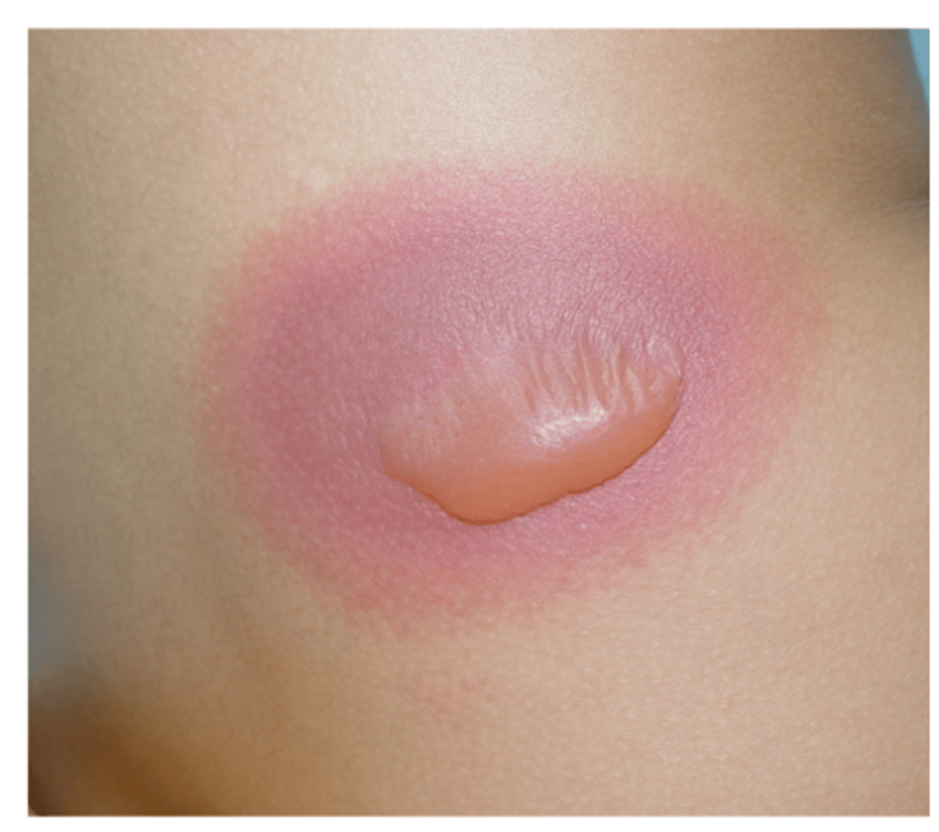 <p>A patient comes in after this "spot" develops on her thigh (oval erythematous plaque with a central bulla). She was taking metronidazole for bacterial vaginosis. She had the same lesion 1 year ago. What is your DX?</p>