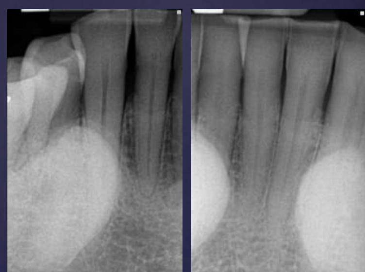 <p>Radiopaque shadow with defined borders superimposed over roots of teeth</p>