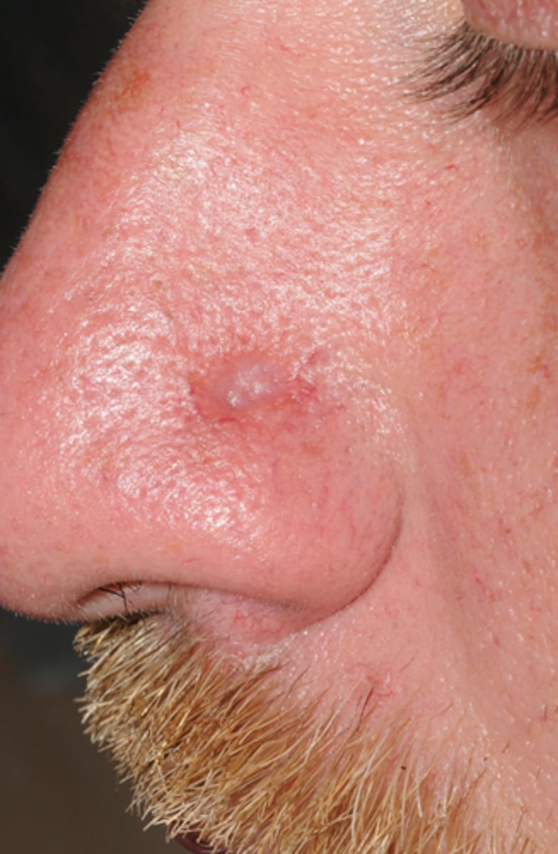 <p>pt is inoculated or infected with the spirochete = chancres</p>