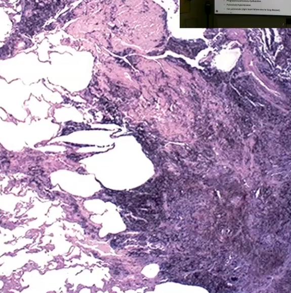<ul><li><p>Lung disorder caused by inhalation of coal dust</p></li><li><p>Caused by inhalation of carbon pigment</p></li><li><p>Carbon pigment/coal is inhaled and engulfed my alveolar and interstitial macrophages, causes inflammation and eventually leads to fibrosis and other complications</p></li><li><p>Starts as Pulmonary Anthracosis, a benign form → Progresses to Coal Worker’s Pneumoconiosis (CWP), where coal macules and coal nodules form, eventually leading to fibrosis and centrilobular emphysema → May complicate into Progressive Massive Fibrosis (PMF) which cause pulmonary dysfunction, pulmonary hypertension and Cor Pulmonale</p></li><li><p>Clinical features include <strong>multiple black scars in lungs, dense collagen and pigment</strong> due to fibrosis</p></li></ul><p></p>