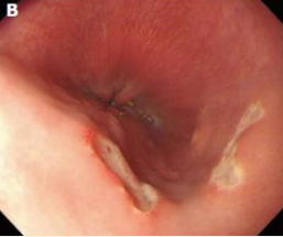 <p><strong>Pill Esophagitis: Diagnosis and Treatment</strong></p><p>-Diagnosis</p><ul><li><p>Clinical</p></li><li><p>___ → severe sx or sx that persist 1 week after discontinuation of med. Single-multiple, ________ ulcers with ______ surrounding mucosa </p></li><li><p>Air contrast barium study → suspect extrinsic compression </p></li></ul><p>-Treatment </p><ul><li><p>____________ likely medication (or substitute for liquid form)</p></li><li><p>Instruct on how to take medications properly → take with at least 8oz of _____ and stand/sit upright for at least 30 minutes after taking med </p></li></ul><p></p>