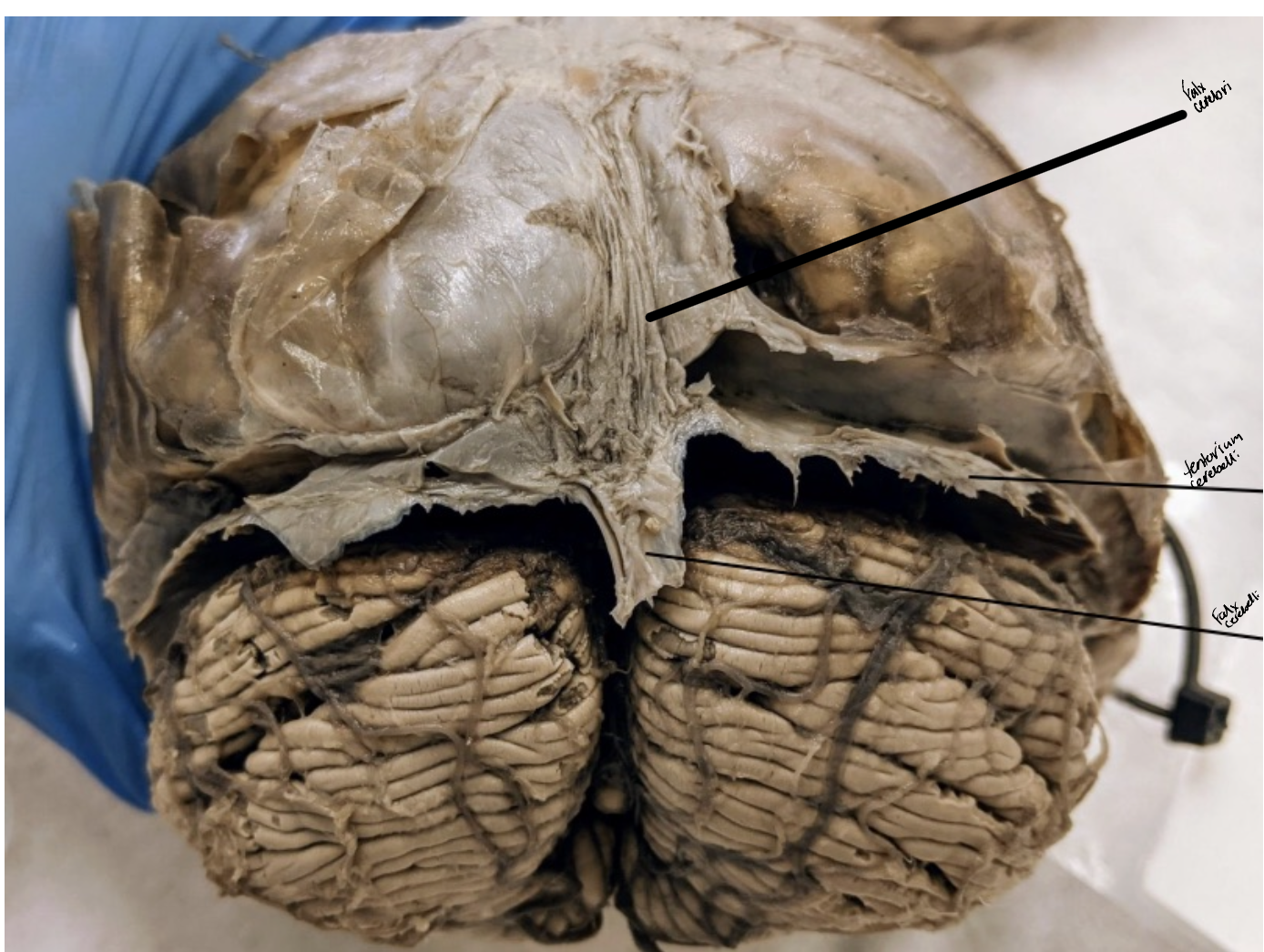 <ul><li><p>Anterior lobe of cerebellum </p></li><li><p>Horizontal fissure </p></li><li><p>Posterior lobe of cerebellum</p></li><li><p>Cerebellar tonsils</p></li><li><p>Posterolateral fissure</p></li><li><p>Superior medullary velum </p></li><li><p>Arbor vitae </p></li><li><p>Folia</p></li></ul><p></p>