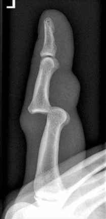 <p>displacement of a bone from its joint </p>