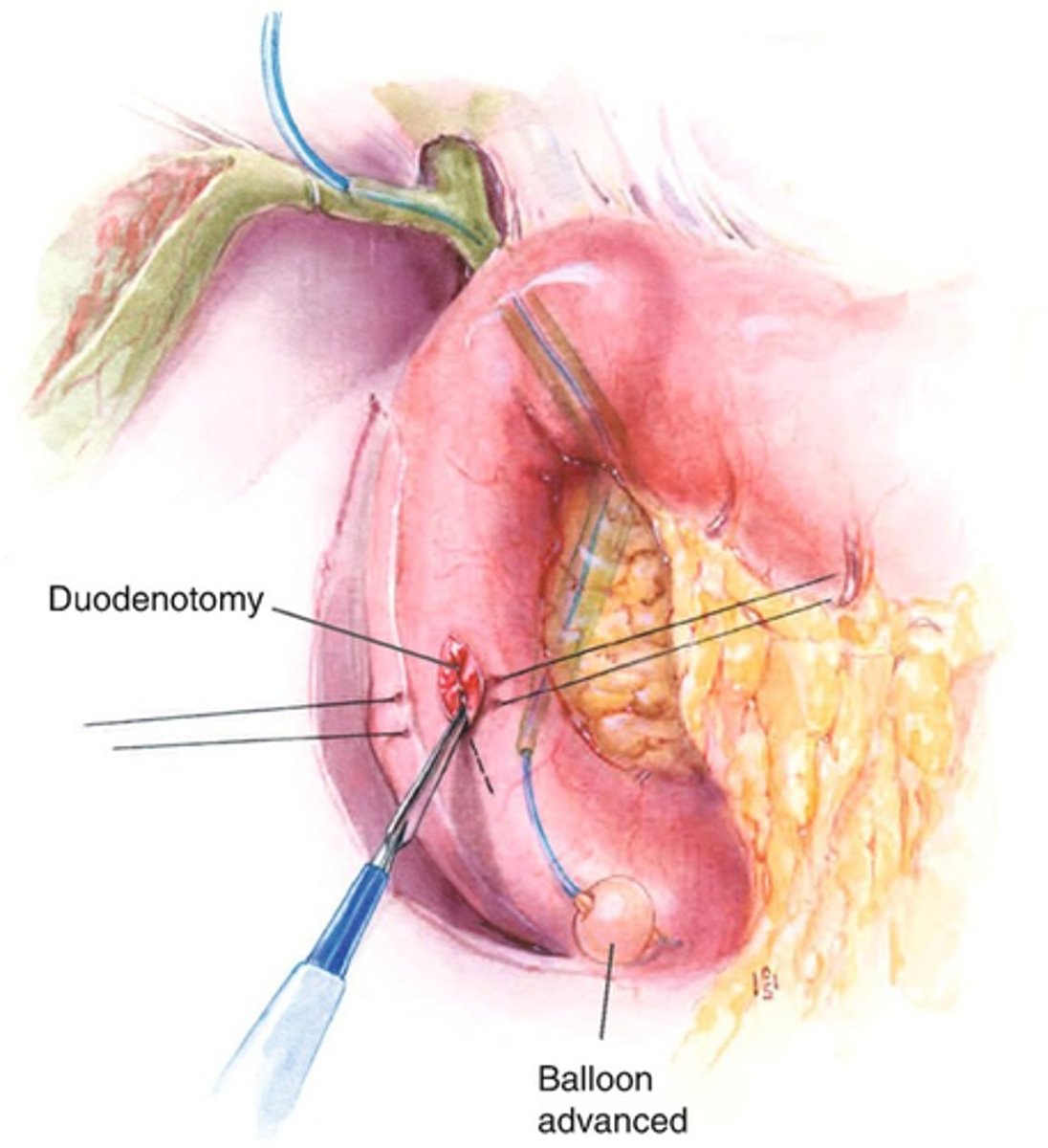 <p>duodenotomy </p><p>+ direct ligation of bleeding vessel in ulcer base </p><p>+ procedure to reduce acid production (truncal vagotomy and pyloroplasty </p><p>OR truncal vagotomy + antrectomy)</p>