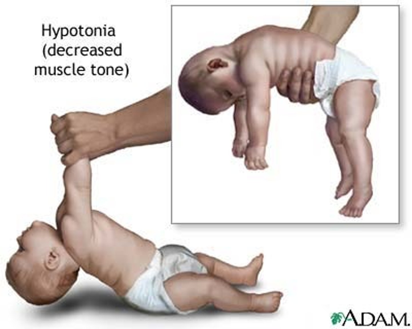 <p>a state in which the muscles are limp and cannot contract (this can happen when <span class="bgY">no neurotransmitter is released from synaptic vesicles</span>)</p>