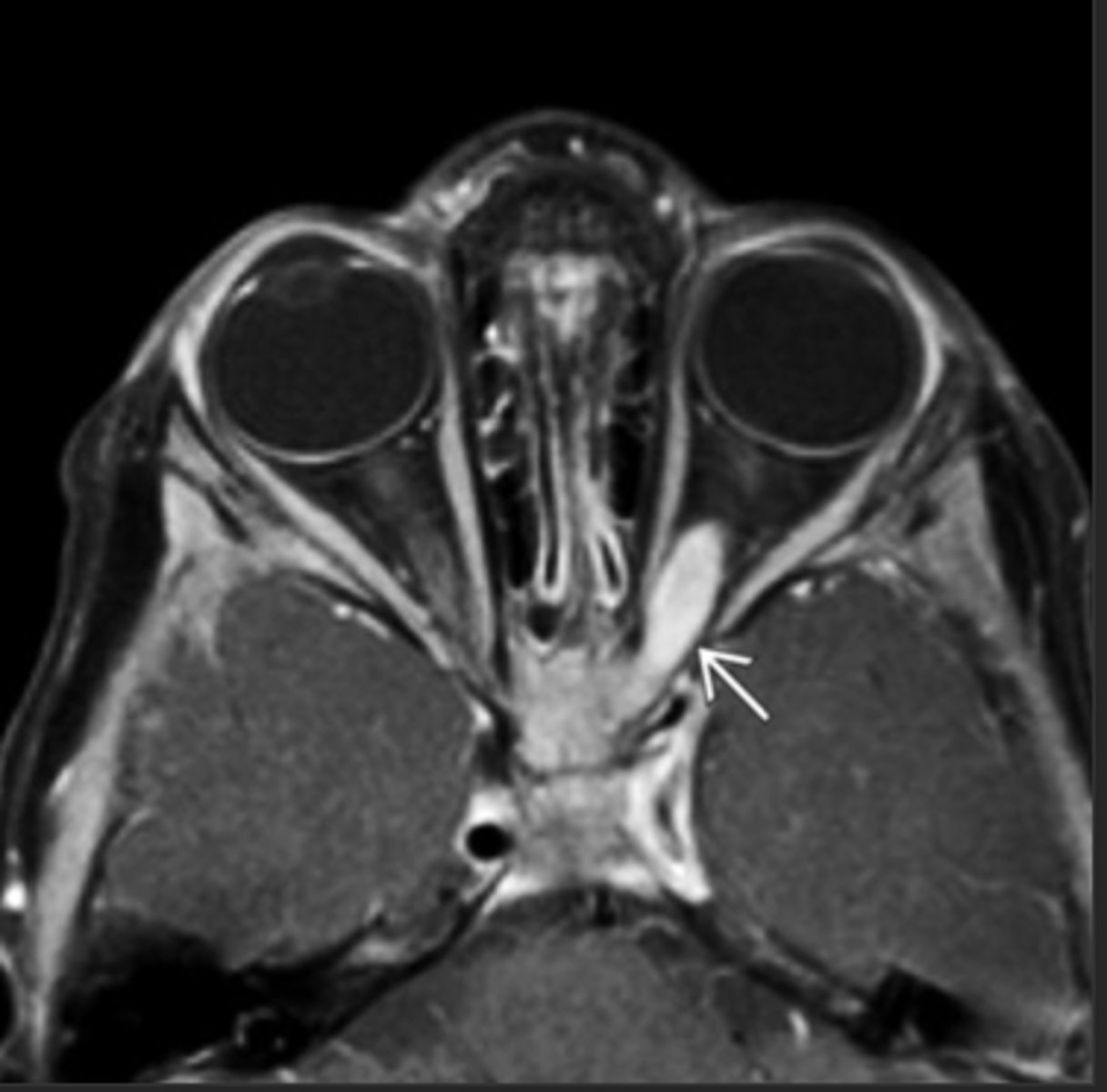 <p>Information for Condition:</p><p>Inflammation of the optic nerve, causing a decrease in visual acuity and changes in color perception</p><p>-May be due to Multiple Sclerosis</p>