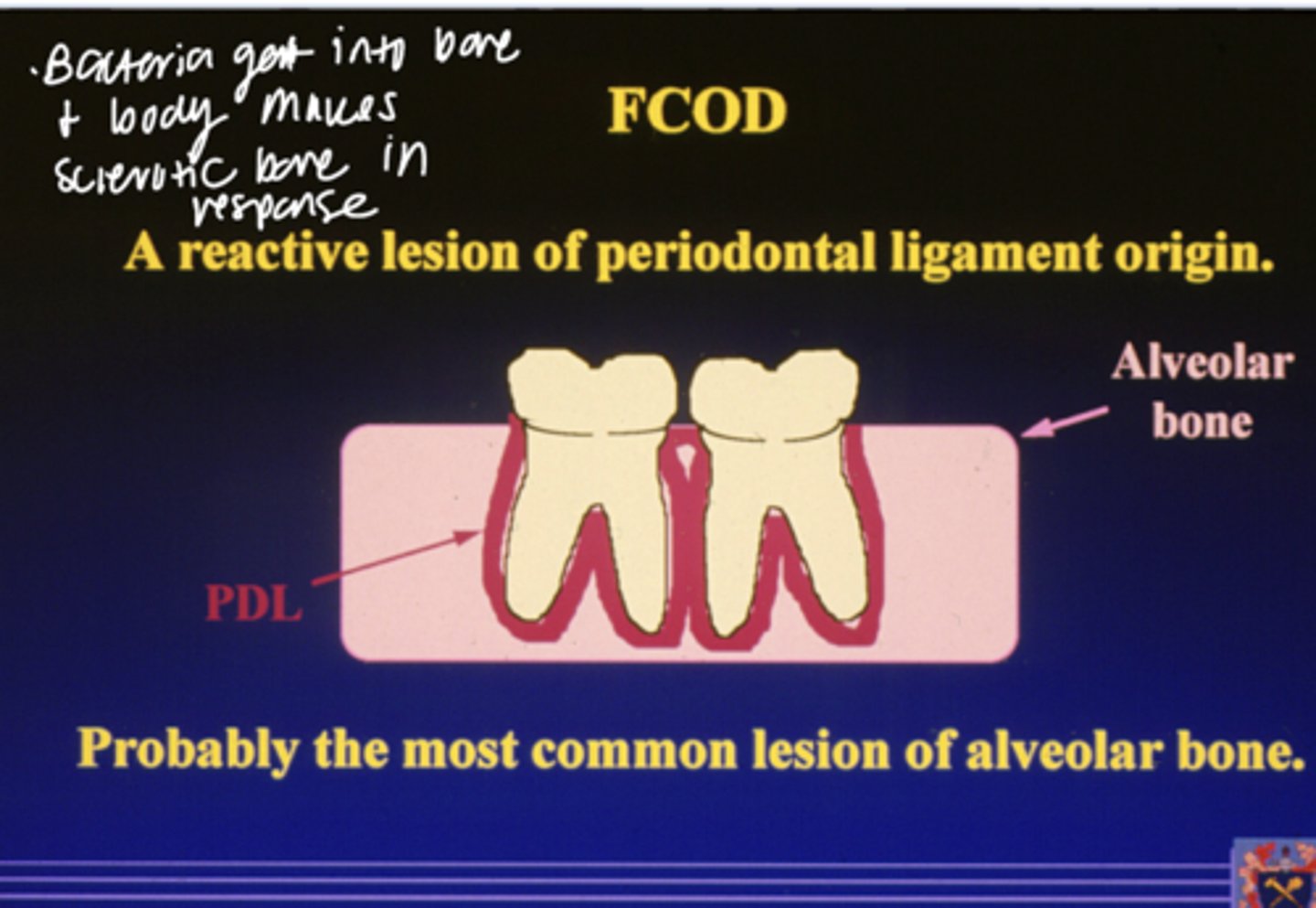 <p>= Focal cemento-osseous dysplasia</p><p>- A reactive lesion of PDL origin</p><p>- Prob most common lesion of alveolar bone</p>