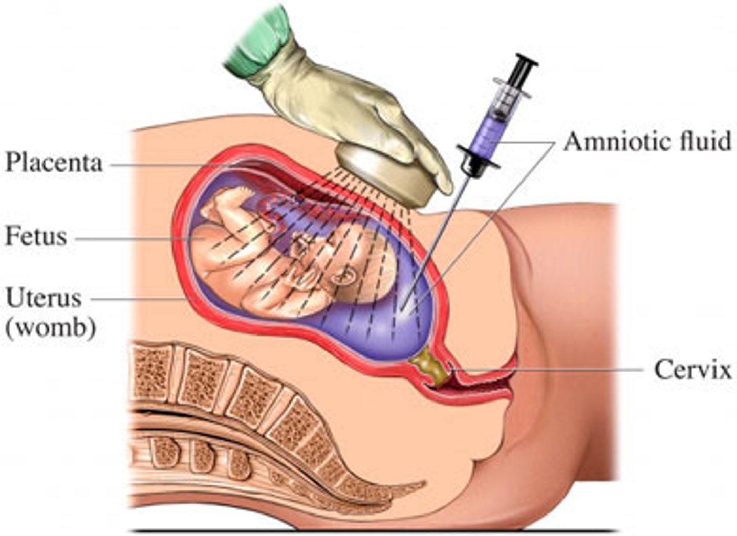 <p>needle puncture of the amniotic sac to withdraw amniotic fluid for analysis. Can determine chromosome abnormalities in the fetus</p>