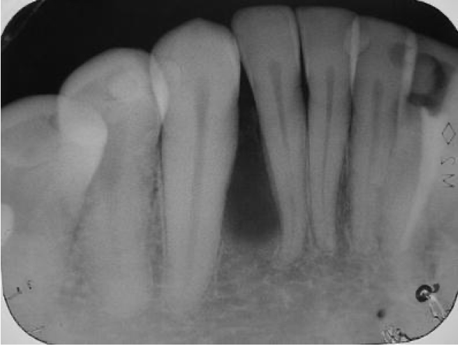 <p>A 51-year-old male patient presented with a well-delimited, radiolucent, mandibular lesion, located between the roots of the right lower lateral incisor and canine and evidenced during routine radiographic examination. Provide 2 differential diagnosis</p>