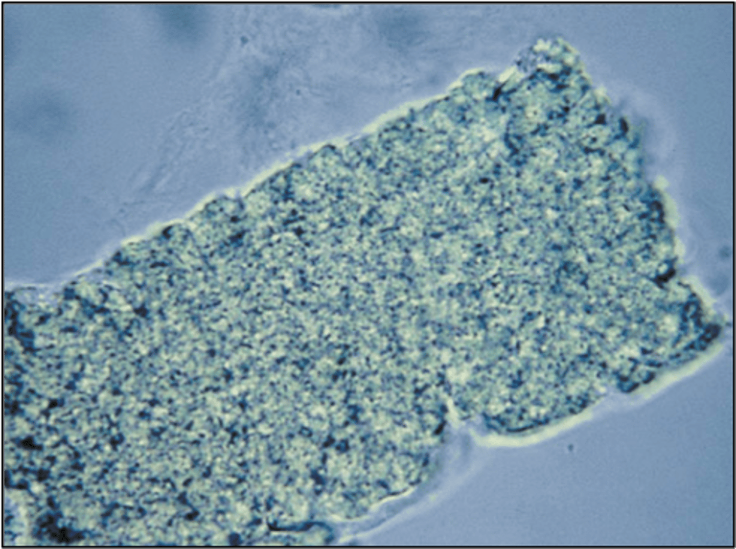 <p>Can occur to any cell type and mean that the cast broadens width wise to be larger than normally expected.</p><p>- Usually indicates renal failure and extreme urinary stasis</p><p>- Indicates the widening of the tubular walls</p><p>- Most commonly seen are granular and waxy</p>