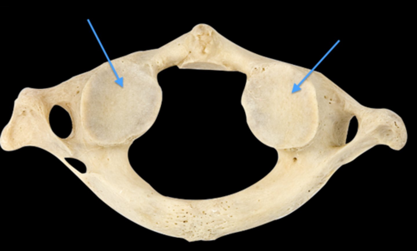 <p>Articular surfaces located on the inferior aspect of vertebrae</p>