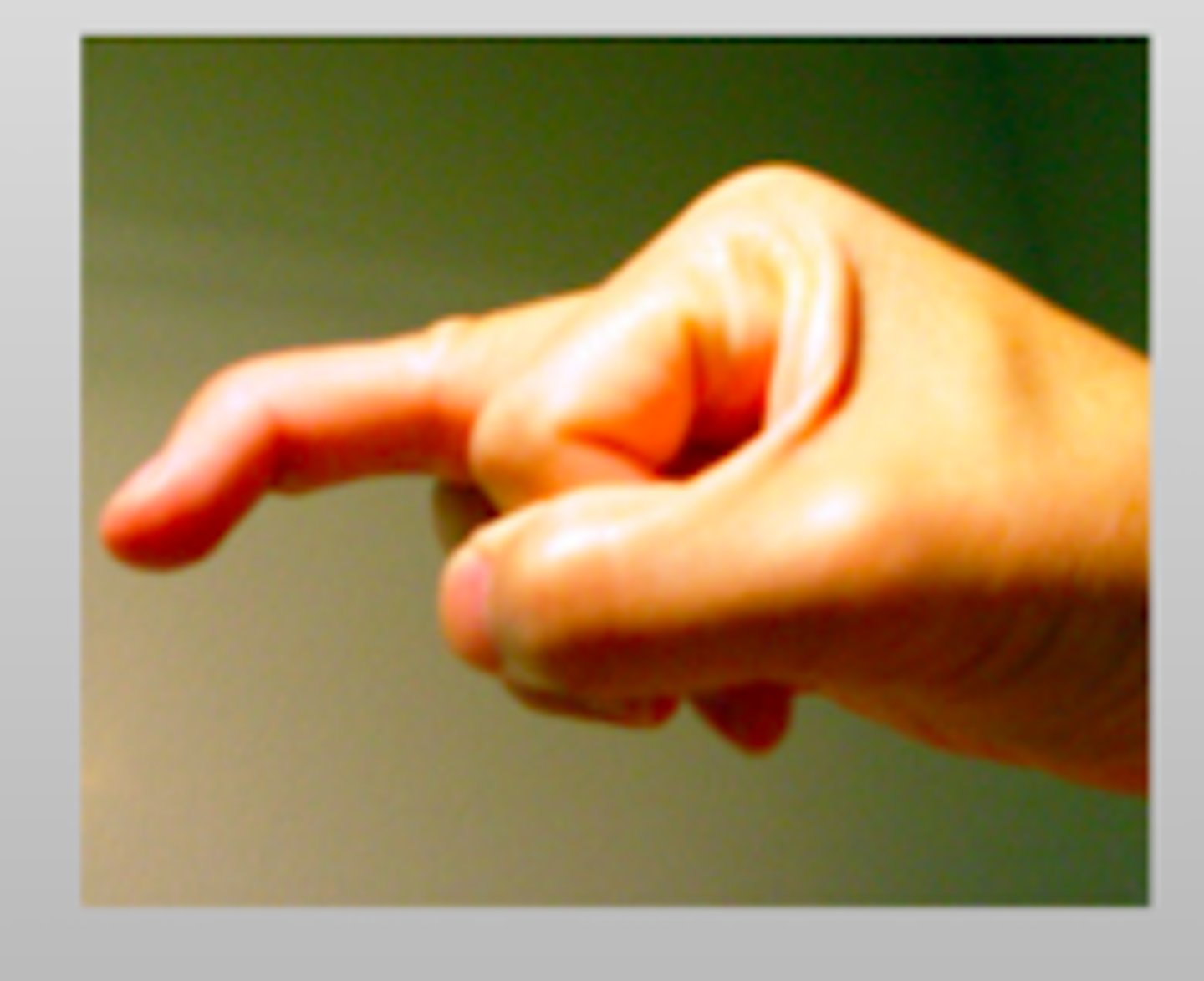 <p>caused by avulsion of the extensor tendon at the distal insertion</p><p>DIP joint will be FLEXED + unable to extend</p>