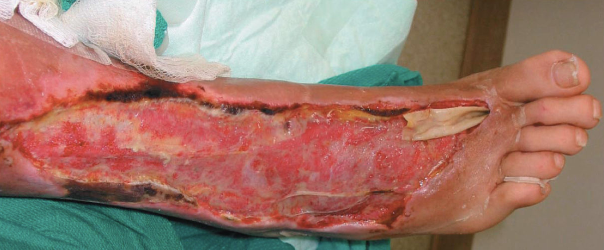 Invasive group A: Streptococcal infection