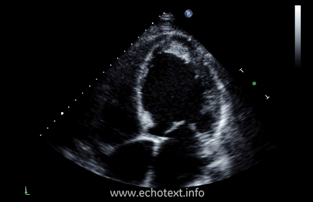 <p><span><span>What cardiac condition is demonstrated in this image?</span></span></p><p>Non-compaction cardiomyopathy</p><p>Metastatic tumor</p><p>Hypertrophic Cardiomyopathy</p><p>LV Apical thrombus</p><p>LV Apical myxoma</p>