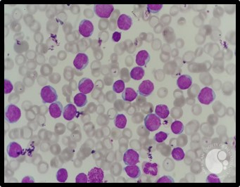 <p>A high count of lymphocytes indicates what?</p>