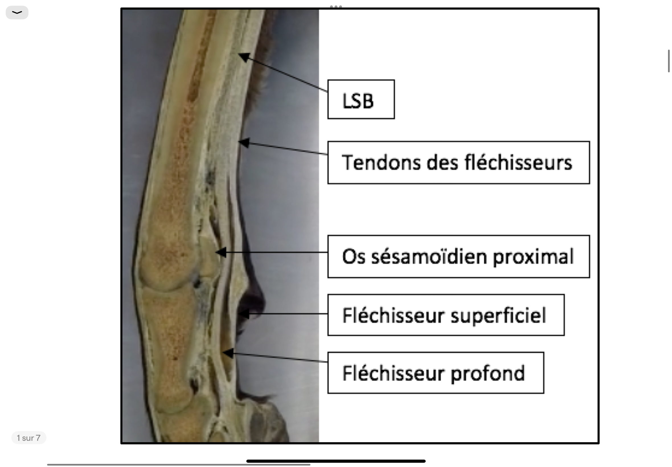 <p></p><p>- Les os sésamoïdes proximaux ont une profonde encoche sur la face abaxiale pour l’insertion du ligament suspenseur du boulet.</p><p>- L’os sésamoïde distal ou os naviculaire (forme d’un petit bateau) présente 2 bords (un bord proximal et un bord distal) et 2 faces : une face tendineuse qu’on appelle aussi la faciès flexoria (parce que le tendon du muscle fléchisseur profond du doigt glisse dessus), et la face articulaire en contact avec la 2ème phalange.</p>
