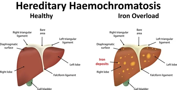 <p>Hemochromatosis</p>