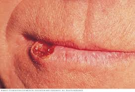 <p>ulceration/plaque not healing</p><p>basal cell carcinoma or squamous cell carcinoma→lower lip</p><p>malignant</p>