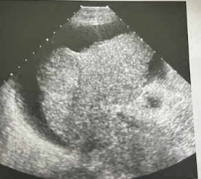 <p>A 77 year old woman undergoes an abdominal sonogram. She is known to have hepatitis C, presumably contracted from a blood transfusion during coronary artery bypass surgery in the 1970s. The sonogram reveals a cirrhotic-appearing, heterogeneous liver. A 1.6cm mass is seen at the periphery of the rt lobe. A large amount of ascites is present. Given the pt’s hx of hepatitis C and the cirrhotic appearance of the liver, what is the most likely diagnosis?</p>