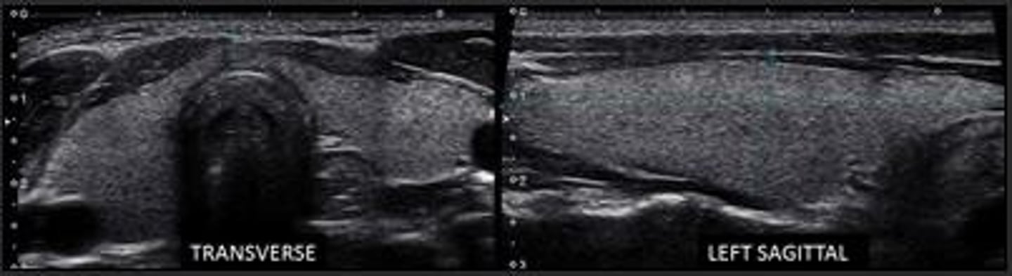 <p>Fine, homogenous echotexture slightly more echogenic than surrounding musculature.</p>