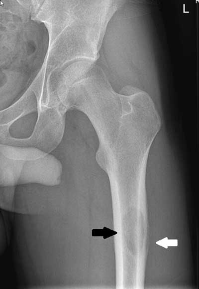 <p>Bone Cyst</p>