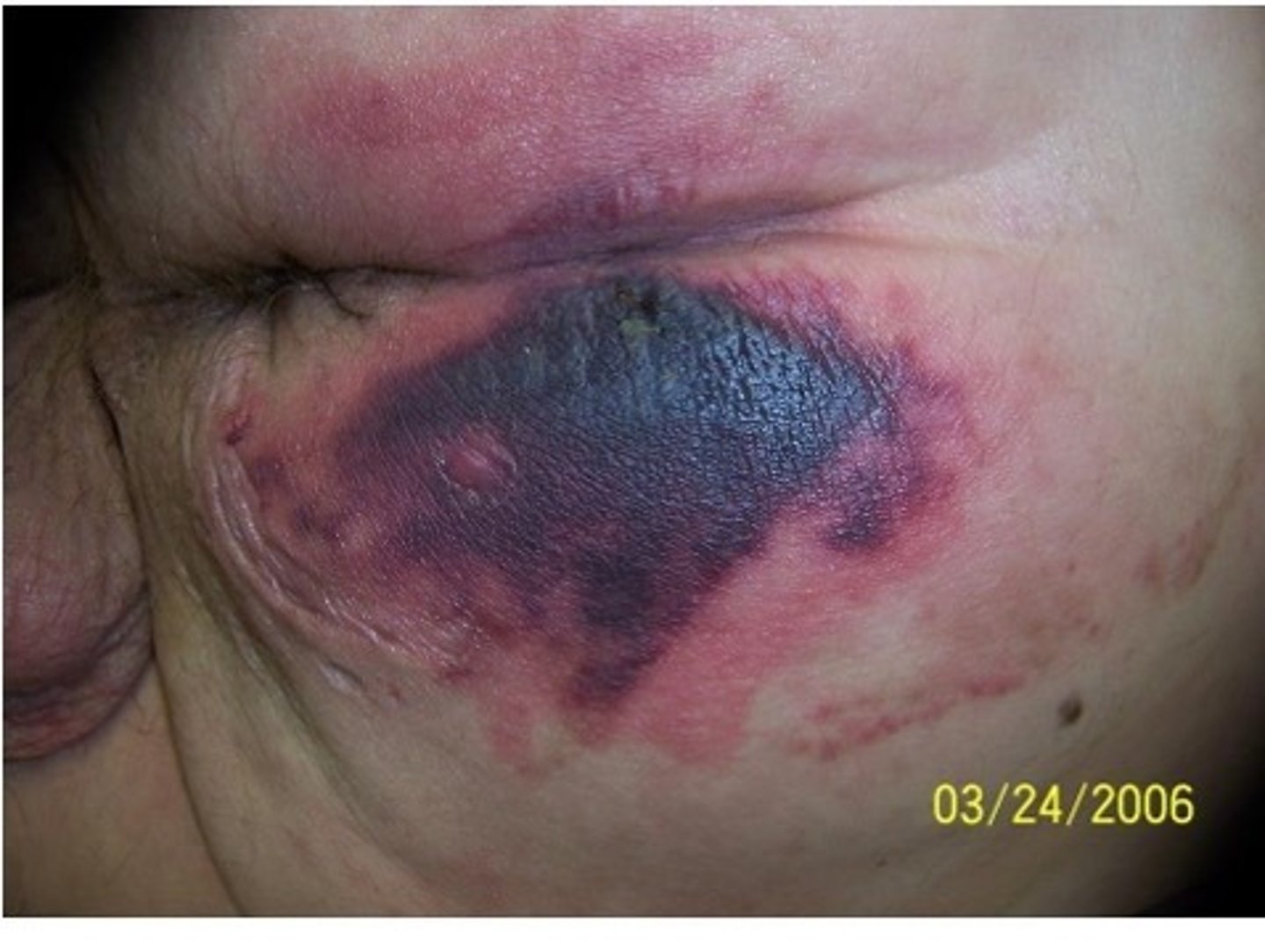 <p>Purple or maroon localized area due to damage of underlying tissue</p><p>Can progress to stage 3 and 4 despite aggressive and optimal treatment</p>