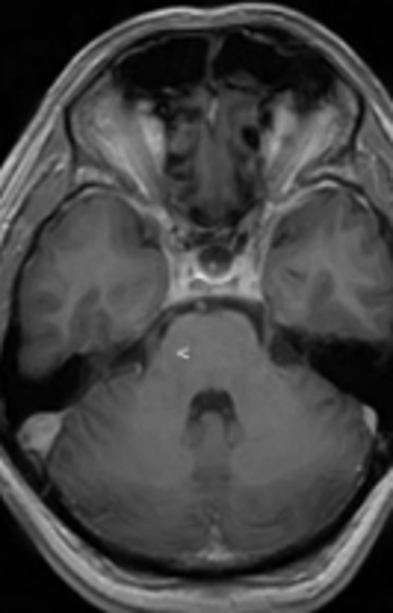 <p>MRI sequence that is similar to T2, but suppresses free water as seen in normal cerebrospinal fluid</p>