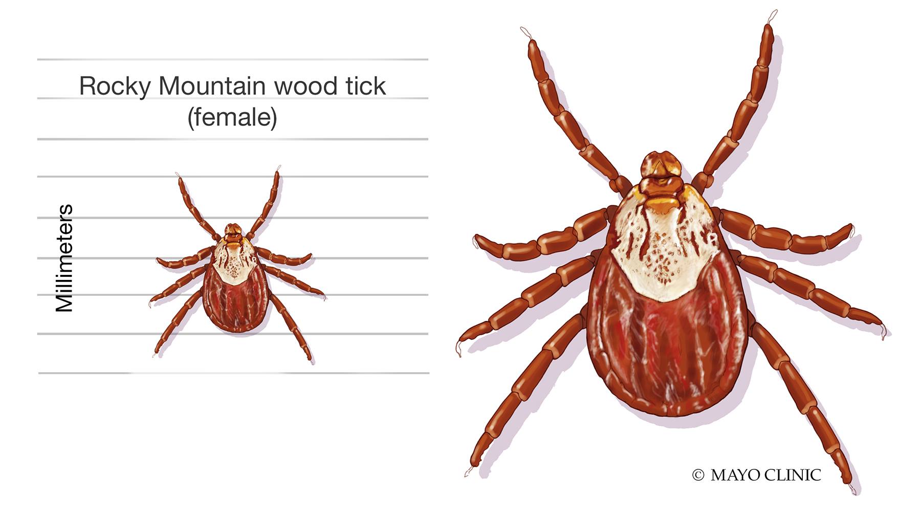 <p>D. Tick</p><div data-type="horizontalRule"><hr></div><p><em>Rickettsia rickettsii</em> is transmitted by <strong>ticks</strong>, primarily the <strong>Dermacentor</strong> species in the U.S. It causes <strong>Rocky Mountain spotted fever (RMSF)</strong>, which features <strong>fever, rash (starting on wrists/ankles), and vasculitis</strong>.</p><p></p>