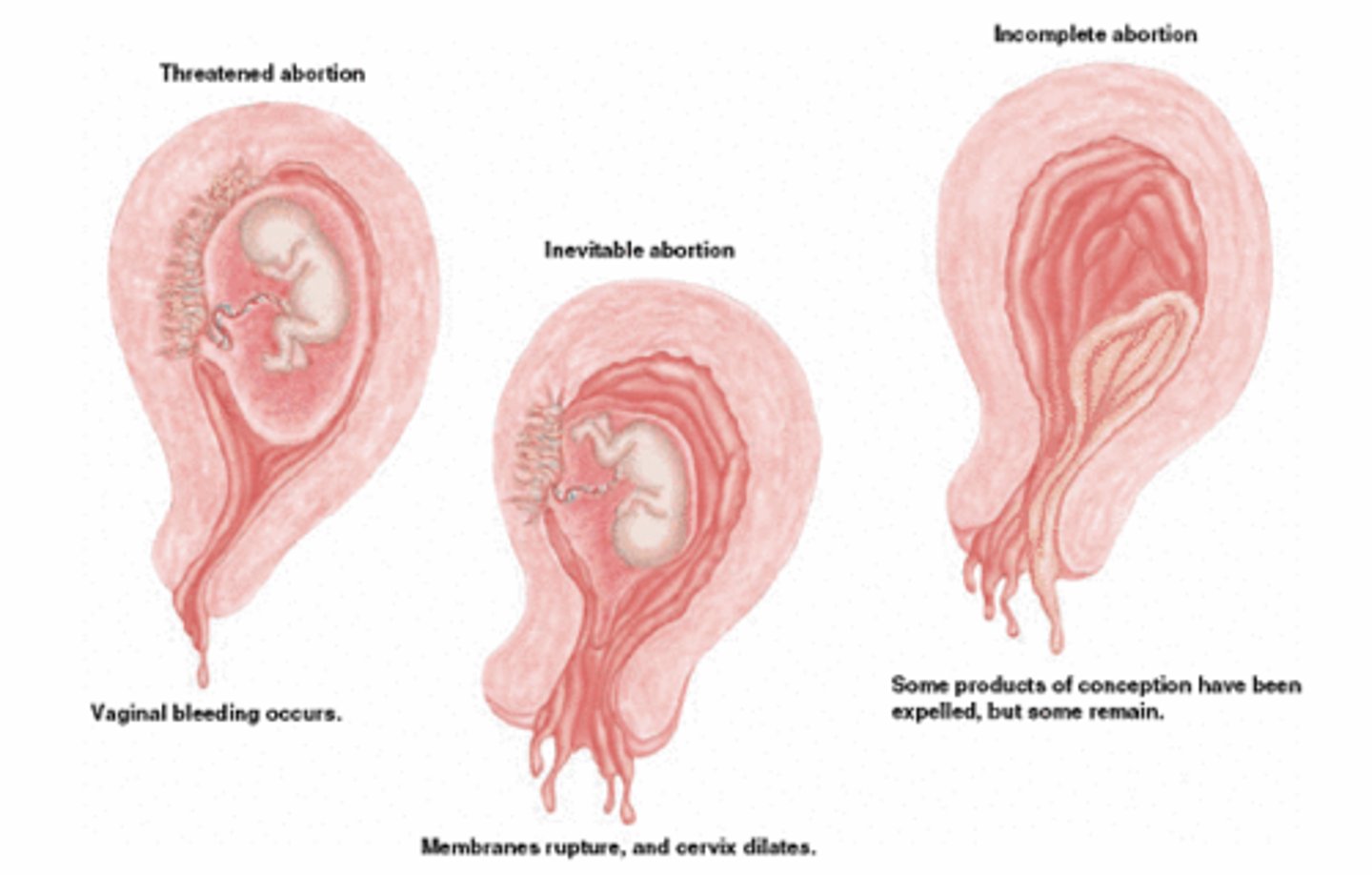 <p>termination of pregnancy by expulsion from uterus of an embryo</p>