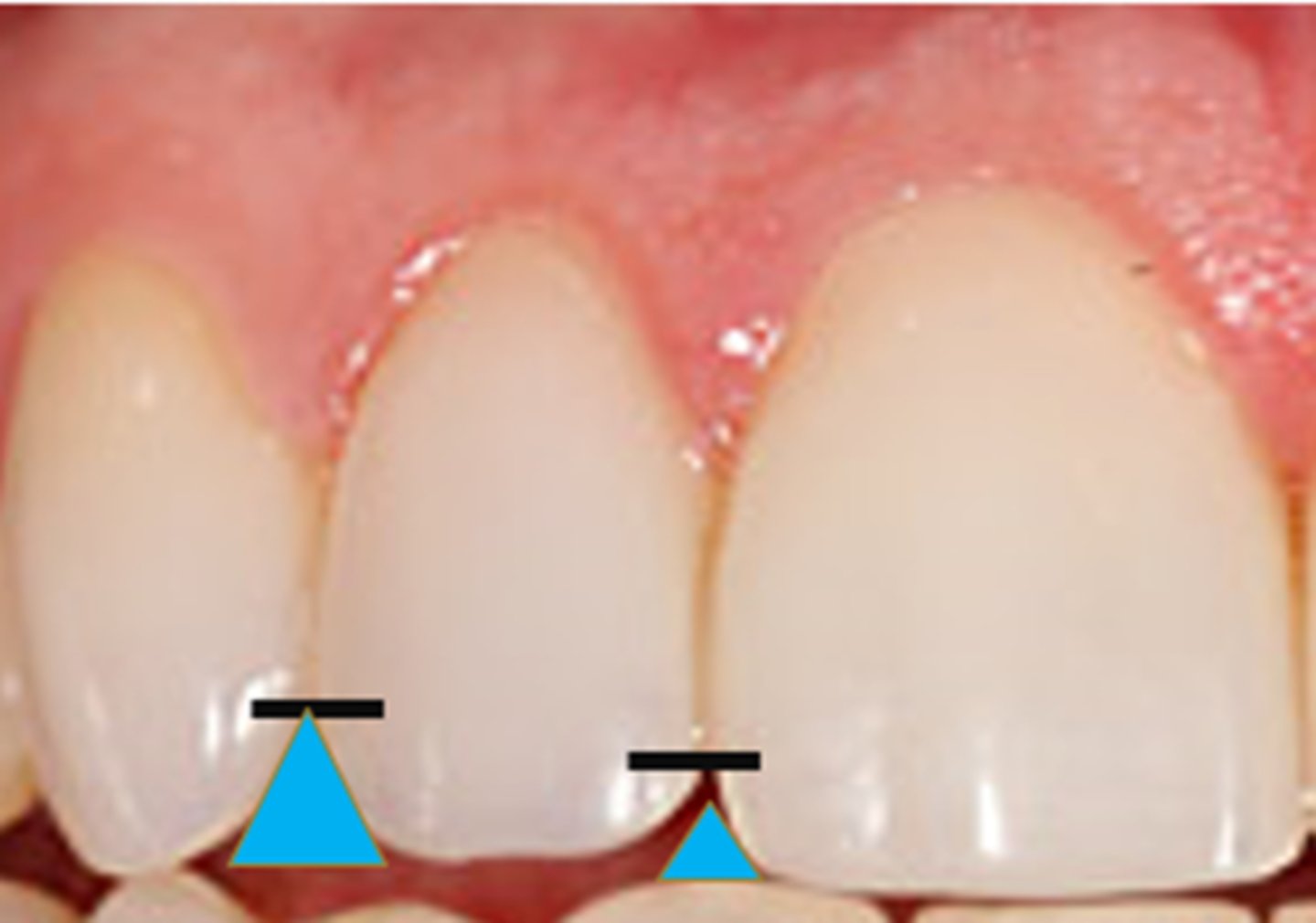 <p>A flattened portion of the tooth where it touches the next tooth in the same dental arch.</p>