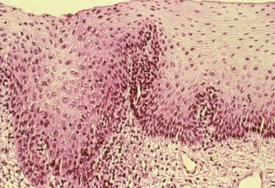 <p>activated metabolic pathways for proliferation; loss of orientation in a tissue. Abnormal appearance of cells</p>