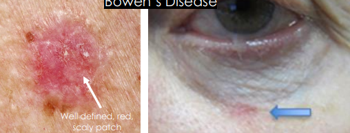 <ol><li><p>• Pre-cancerous, Non-invasive but can convert to Invasive SCC</p></li><li><p>•<strong><u> Well defined, red, crusted, </u></strong>keratotic, scaly lesion, similar to actinic keratosis</p></li><li><p>• May resemble psoriasis or eczema</p></li></ol><p></p>