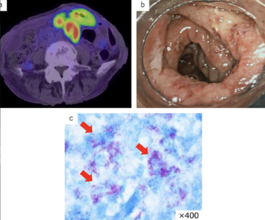 <p>Enteritis, thickened mucosa, malabsorption, diarrhea, weight loss </p>