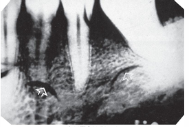 <p>How would you resolve this FINGERNAIL ARTIFACT X-ray?</p>