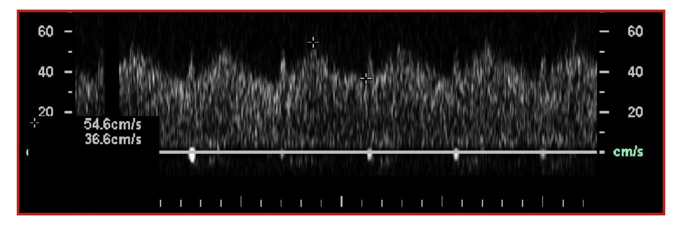 <p>What is this waveform? its in the vertebral artery </p>