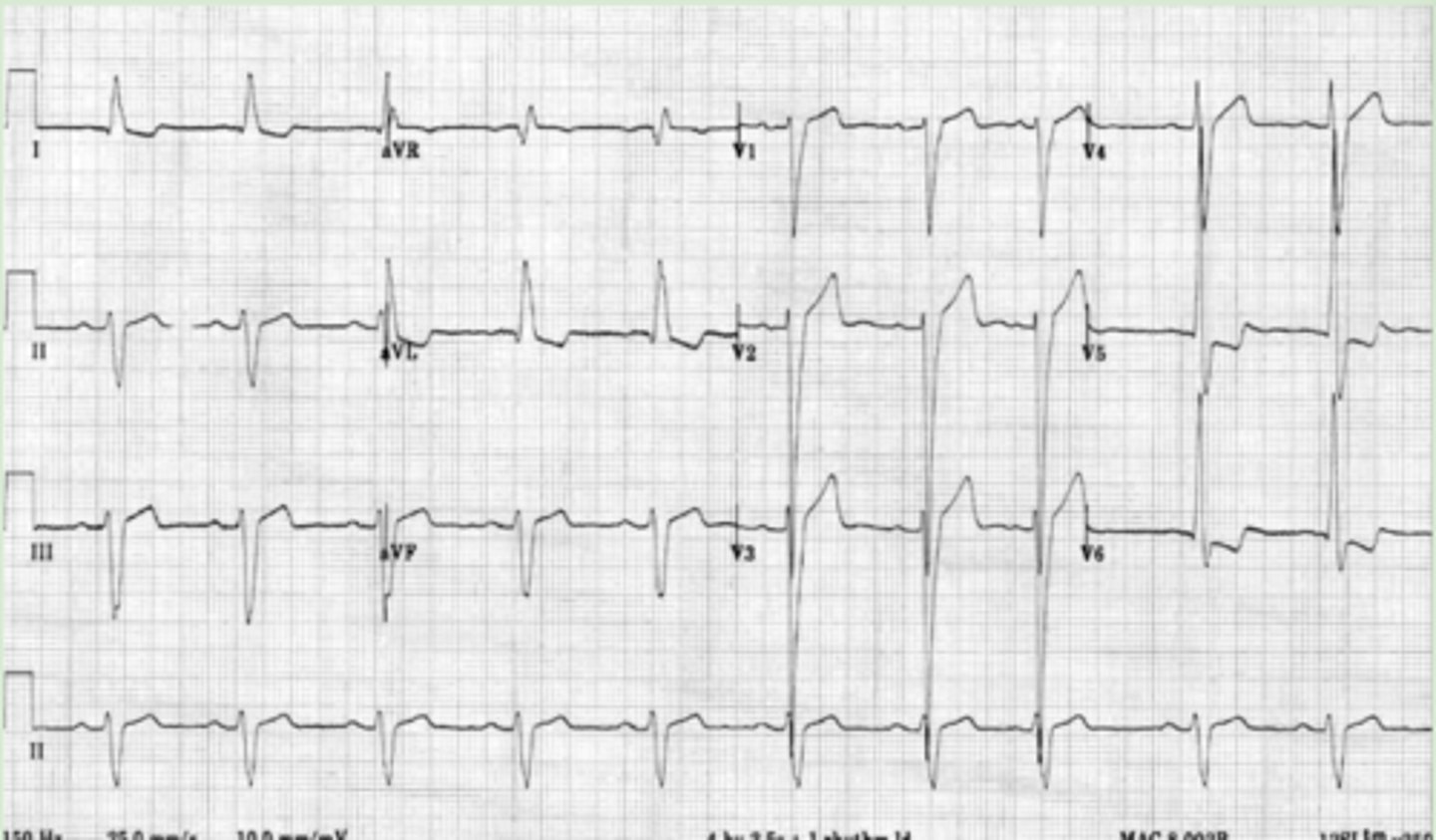 <p>I, aVL = Increased amplitude of R waves</p><p>III, aVR, V1-V3 = Increased depth of S waves</p><p>V5-V6 = Tall R waves</p><p>-Will also see ST &amp; T wave abnormalities consistent w/ LV strain</p>