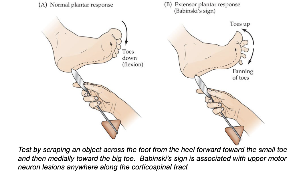 <ul><li><p>testing for Babinski’s sign</p></li><li><p>flexion = normal</p></li><li><p>extension (toes fanning and upward) = Babinski’s sign</p></li></ul><p></p>