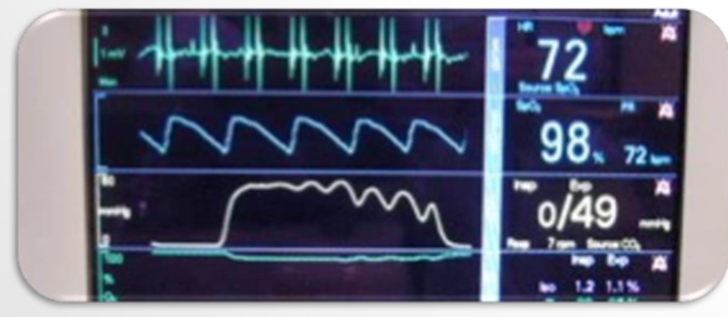 <p>What could cause this capnograph?</p>