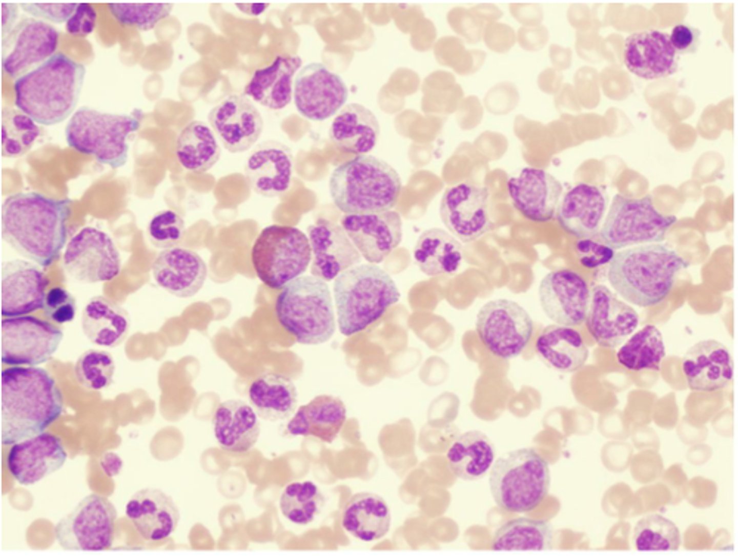 <p>There is a reversal of the normal RBC to WBC ratio --&gt; now more WBCS than RBCS --&gt; "white blood"</p>