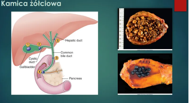 <ul><li><p>10-20% populacji</p></li><li><p>wzrost występowania z wiekiem</p></li><li><p>M:K = 1:2</p></li><li><p>czynniki środowiskowe:</p><ul><li><p>estrogeny</p></li><li><p>otyłość</p></li></ul></li><li><p>czynniki dziedziczne i etniczne:</p><ul><li><p>częściej Azjaci</p></li><li><p>historia rodzinna!!</p></li></ul></li><li><p>czynnika ryzyka:</p><ul><li><p>zespoły hemolityczne</p></li><li><p>bypassy jelitowe</p></li><li><p>zakażenia bakteryjne dróg żółciowych</p></li></ul></li><li><p>powikłania:</p><ul><li><p>ostre i przewlekłe zapalenie pęcherzyka żółciowego</p></li><li><p>nadkażenie bakteryjne → zapalenie przewodzików żółciowych → posocznica</p></li><li><p>pęknięcie pęcherzyka → zapalenie otrzewnej</p></li><li><p>przetoki żółciowo-jelitowe</p></li><li><p>zaostrzenie dotychczasowych przewlekłych chorób wątroby, serca, płuc i nerek</p></li><li><p>rak pęcherzyka żółciowego</p></li></ul></li></ul><p></p>