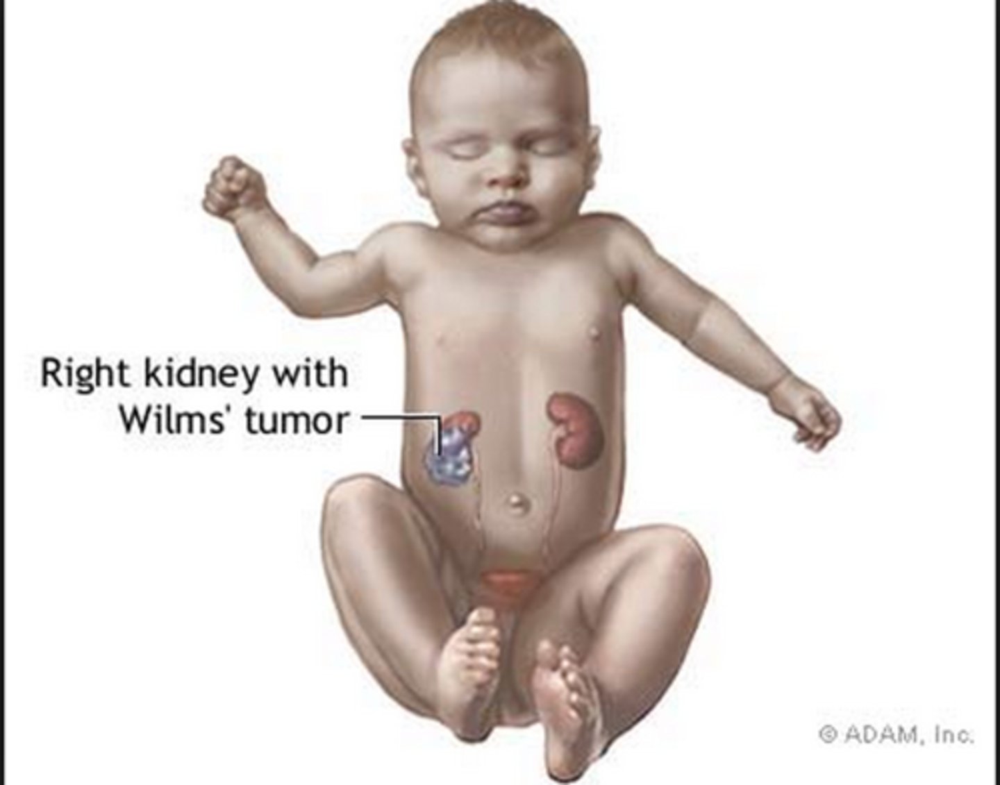 <p>Most common childhood renal tumor; WAGR syndrome (Wilm's tumor, aniridia, GU abnormalities, range of developmental delays); an incidental flank mass &amp; possible hematuria</p>