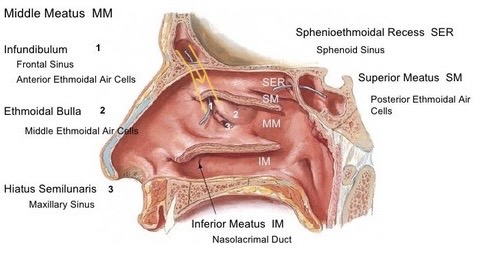 <p>Infundibulum towards Hiatus semilunaris of Middle meatus in the nasal cavity.</p>